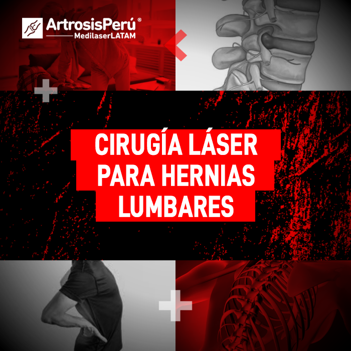 La cirugía láser hernias es un tratamiento avanzado. Infórmate sobre su efectividad y beneficios médicos.