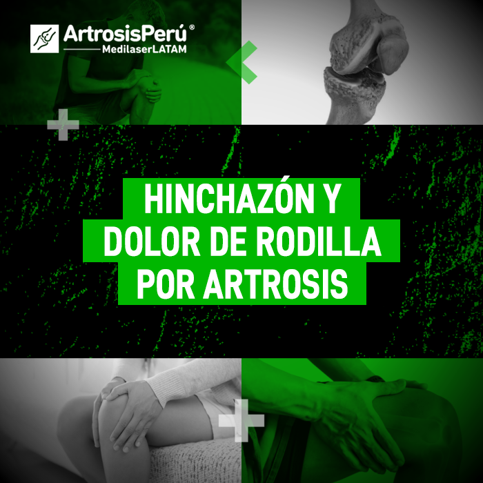 Descubre los tratamientos recomendados para combatir el dolor de rodilla y la inflamación articular provocados por el desgaste.