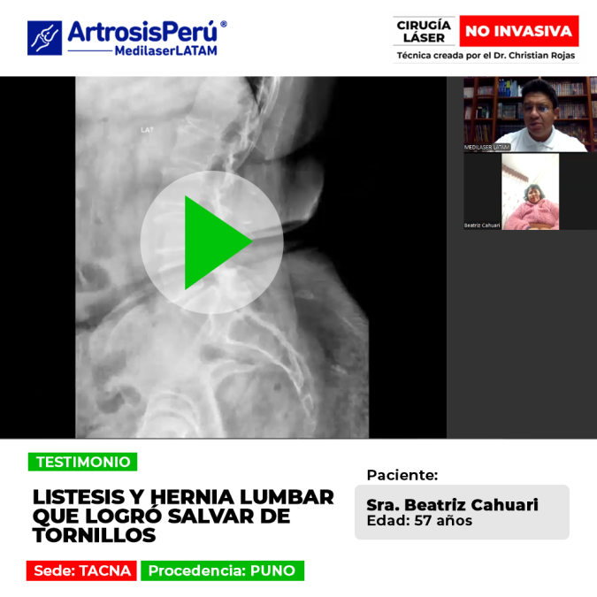 Conoce la historia de la paciente que logró evitar una cirugía compleja de fijación gracias a un tratamiento efectivo para la hernia lumbar.