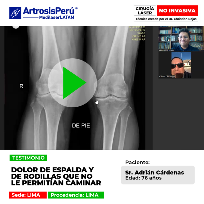 ¿Sufres de rigidez articular generalizada? Descubre el testimonio del paciente que superó el dolor de espalda y volvió a caminar.