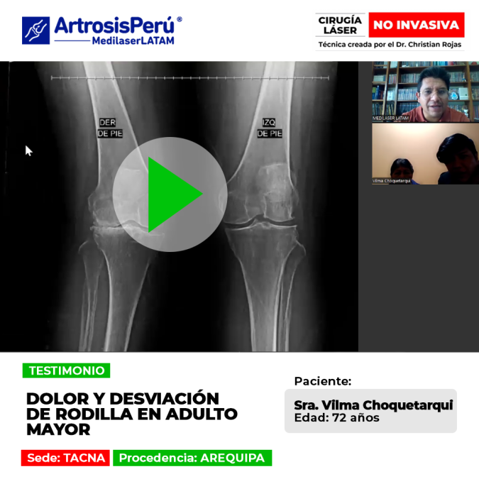 Infórmate sobre el tratamiento alternativo que ayudó a corregir la desviación de rodilla y aliviar las molestias físicas crónicas.