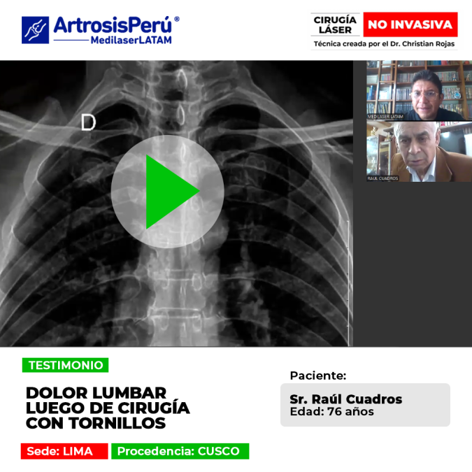 Entérate de la historia del paciente que sufría un severo dolor lumbar tras una operación de columna y cómo halló una alternativa efectiva.