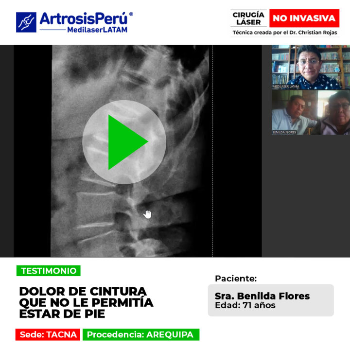 ¿Sufres de un dolor de cintura incapacitante? Descubre el tratamiento médico que ayudó a una paciente a recuperar su movilidad y bienestar.