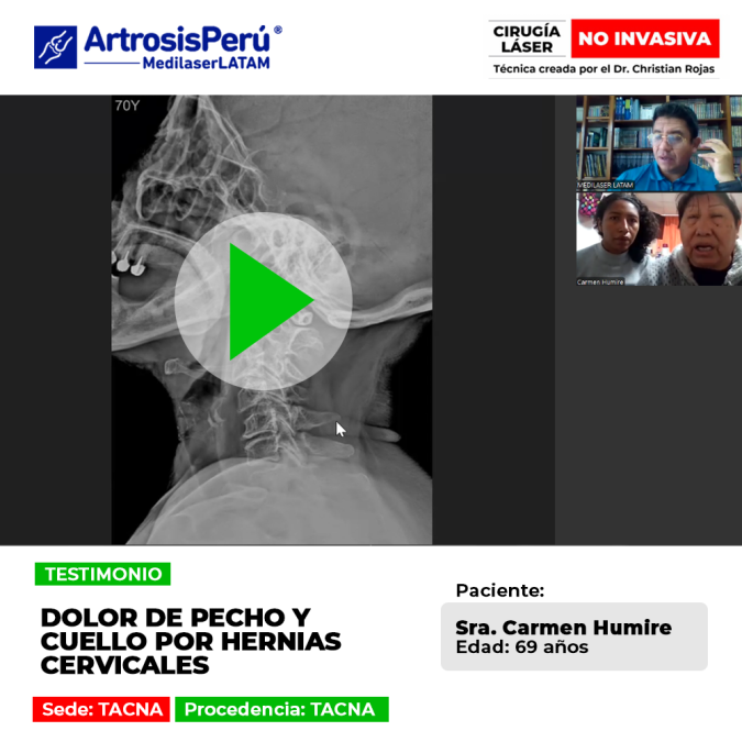 Conoce la historia de la paciente que lidiaba con un incapacitante hernias cervicales que afectaba su pecho y cuello, y descubre cómo se recuperó.