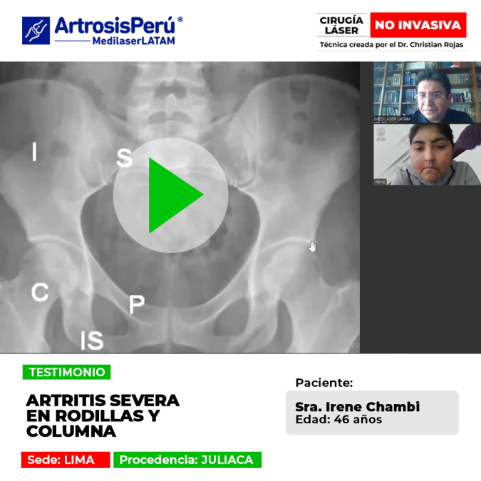 Sorpréndete con el testimonio de superación de una paciente que sufría de artritis severa en sus articulaciones y encontró una solución para su dolor.