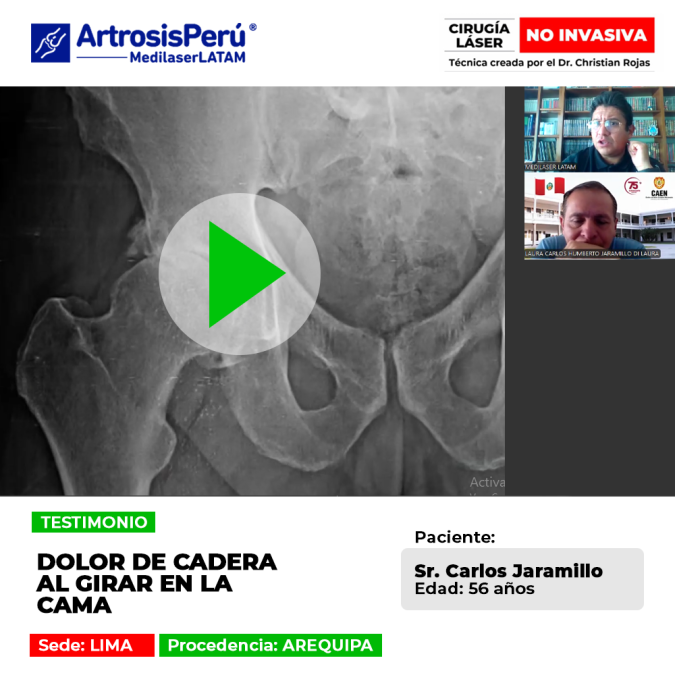 El dolor de cadera al girar en la cama atormentaba a este paciente de Arequipa. Descubre el tratamiento que devolvió su descanso.