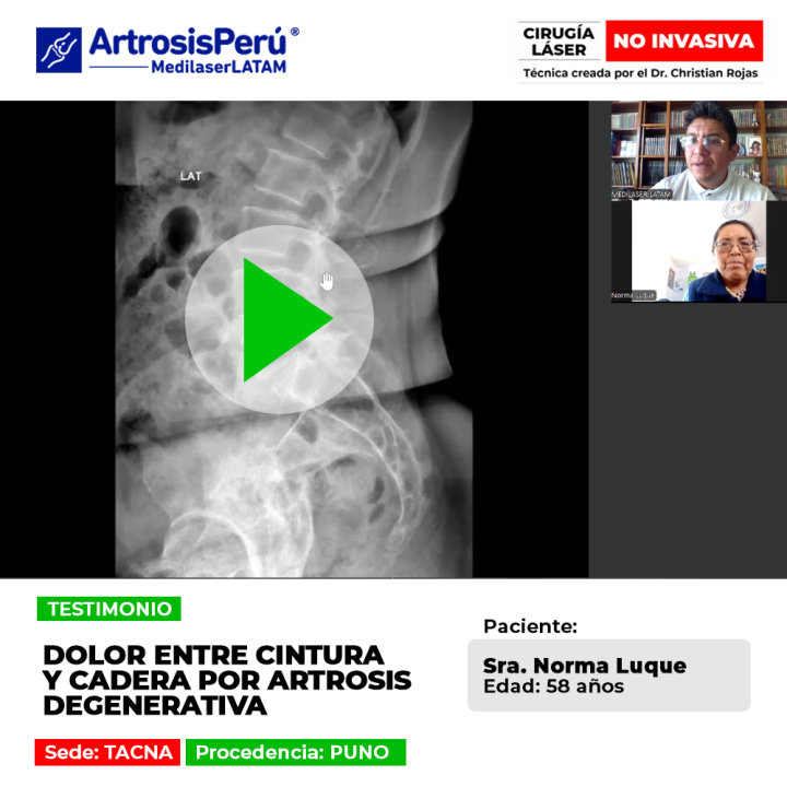 La artrosis degenerativa causaba un fuerte dolor entre la cintura y cadera a esta paciente de Puno. Conoce su historia de recuperación.