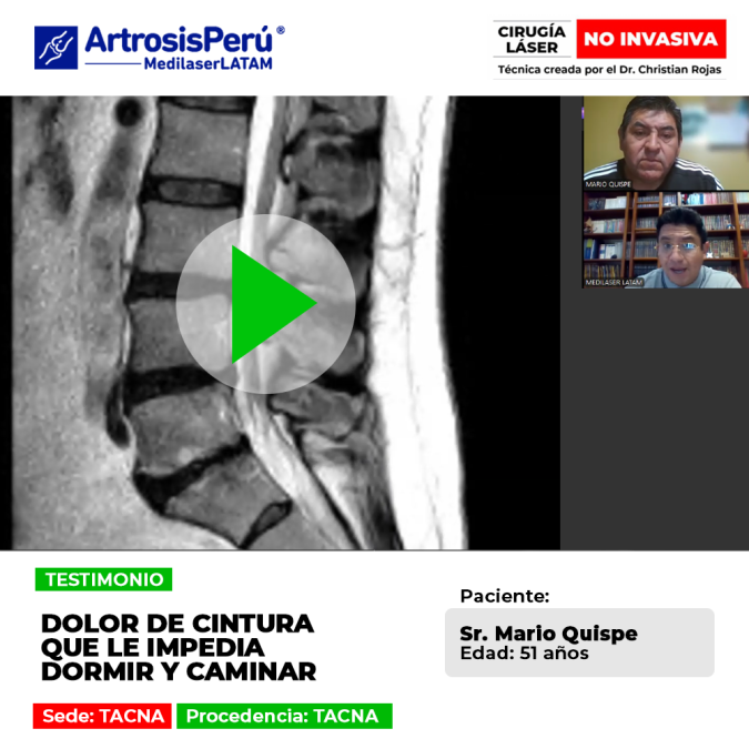 El dolor de cintura severo e invalidante puede impedir el descanso y la movilidad. Conoce este caso de recuperación efectiva.