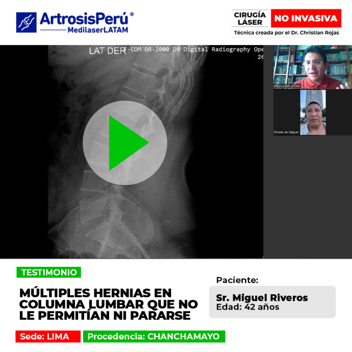 Las hernias columna lumbar severas pueden impedir ponerse de pie. Infórmate sobre procedimientos para superar la dolencia.