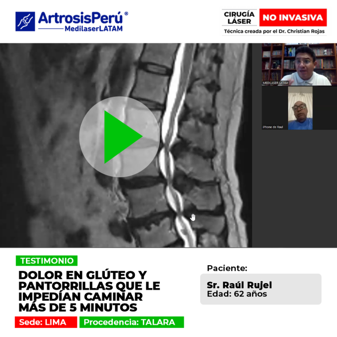 Dolor en glúteo: conoce las causas de esta molestia al caminar y las opciones de tratamiento para recuperar la movilidad.