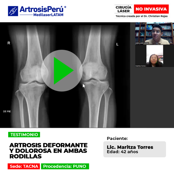 Artrosis deformante en rodillas: aprende sobre sus efectos en la articulación y los tratamientos para controlar el dolor.