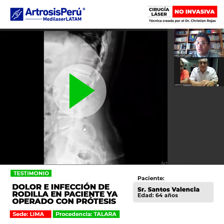 Infección de prótesis de rodilla: conoce las causas de este dolor posoperatorio y cómo debe abordarse médicamente.