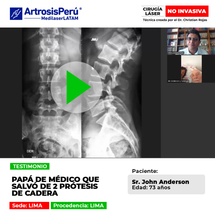 La prótesis de cadera puede evitarse mediante tratamientos oportunos. Conoce este caso médico de éxito y recuperación articular.