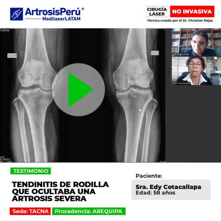 La artrosis severa rodilla puede confundirse con lesiones leves. Conoce la importancia de un diagnóstico médico certero y oportuno.