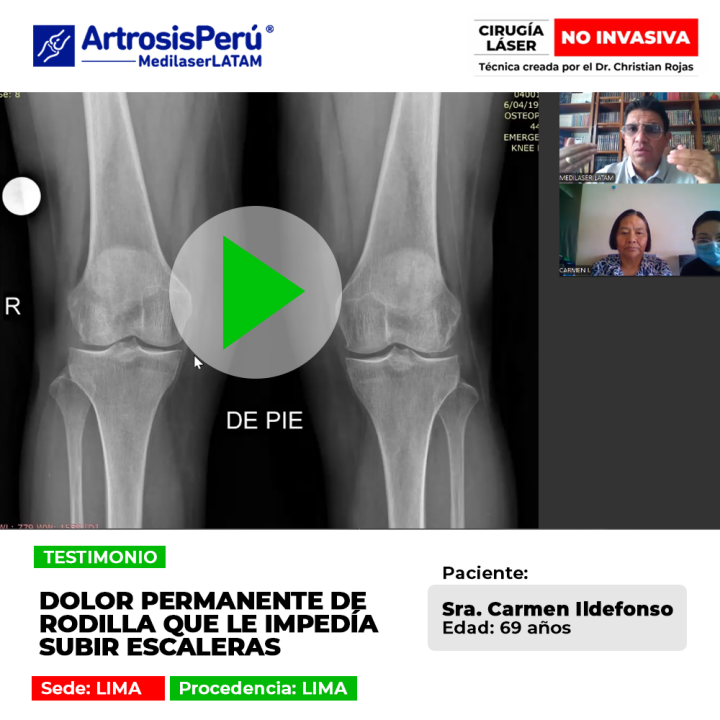 El dolor de rodilla constante complica actividades cotidianas como subir gradas. Conoce alternativas efectivas de recuperación.