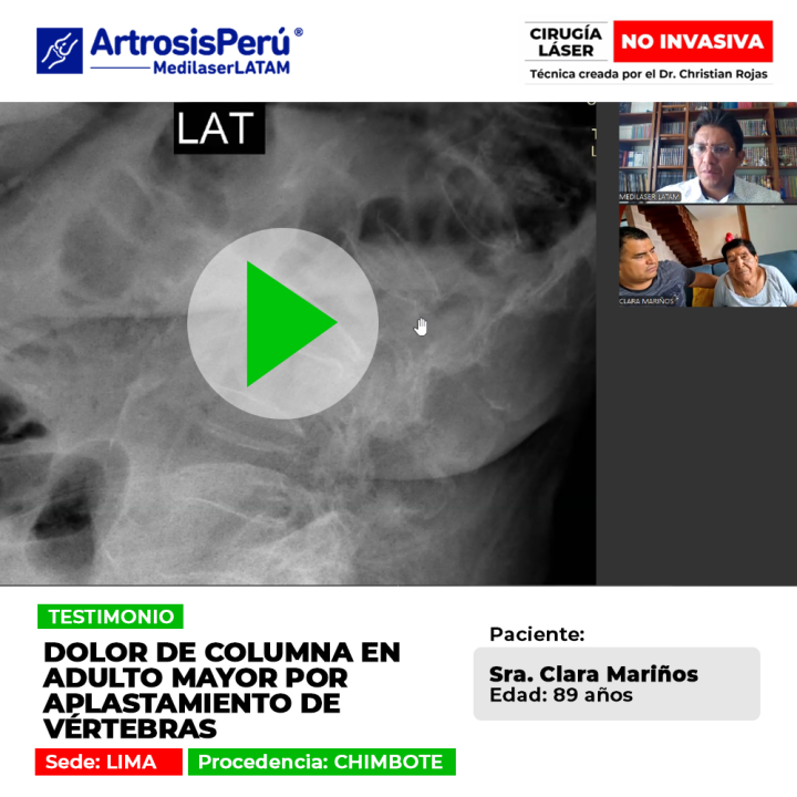 El aplastamiento de vértebras genera dolor agudo en la columna del adulto mayor. Conoce procedimientos médicos para su alivio.