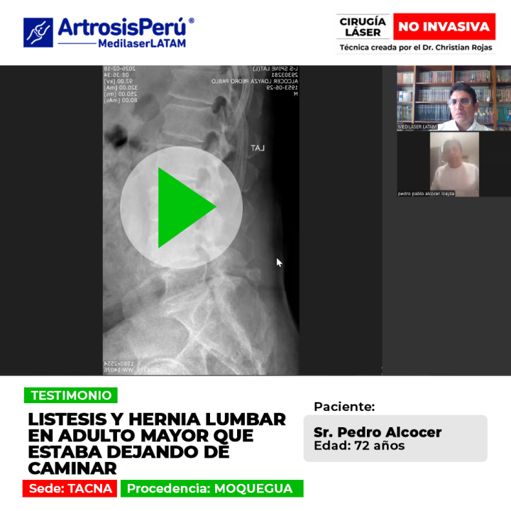 La listesis lumbar y las hernias pueden reducir la marcha en adultos mayores. Conoce alternativas efectivas para recuperar el andar.