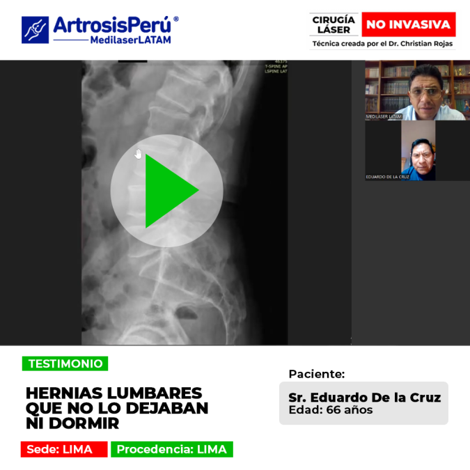 Las hernias lumbares agudas causan intensos dolores que impiden conciliar el sueño. Conoce procedimientos médicos para el alivio.