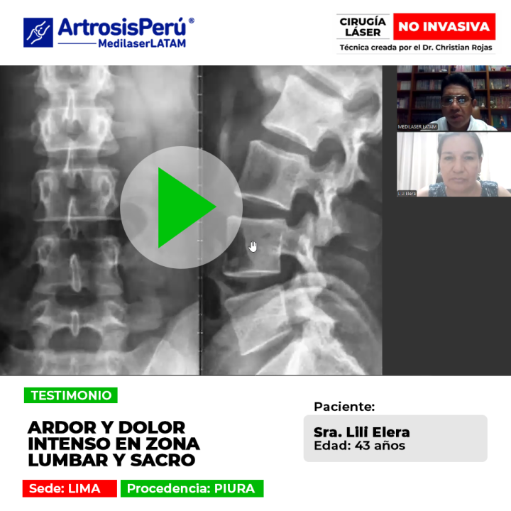 El dolor en zona lumbar y sacro suele vincularse a compromiso nervioso. Infórmate sobre tratamientos oportunos para su control.