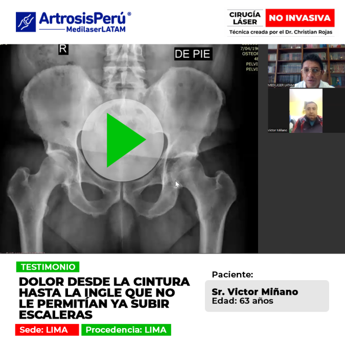 El dolor de cintura irradiado hacia la ingle limita el movimiento cotidiano. Conoce tratamientos especializados para subir escaleras sin dolor.