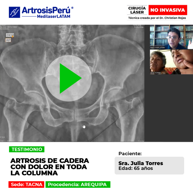 La artrosis de cadera puede irradiar tensión y dolor a lo largo de la columna. Infórmate sobre procedimientos médicos para su control.
