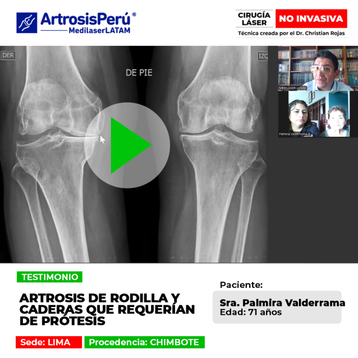 La artrosis de rodilla y cadera avanzada puede tratarse sin prótesis. Descubre opciones médicas efectivas para salvar la articulación.