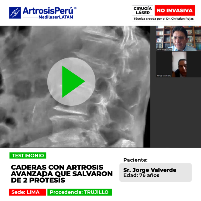 Las caderas con artrosis avanzada pueden recuperarse evitando prótesis. Conoce alternativas médicas seguras para volver a caminar bien.