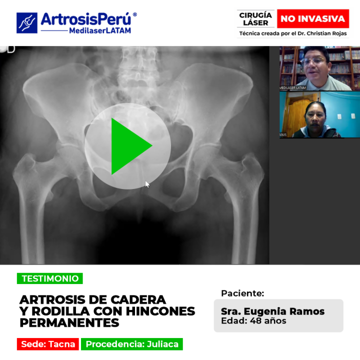 La artrosis de cadera y rodilla genera hincones punzantes continuos. Descubre opciones médicas efectivas para frenar el daño articular.