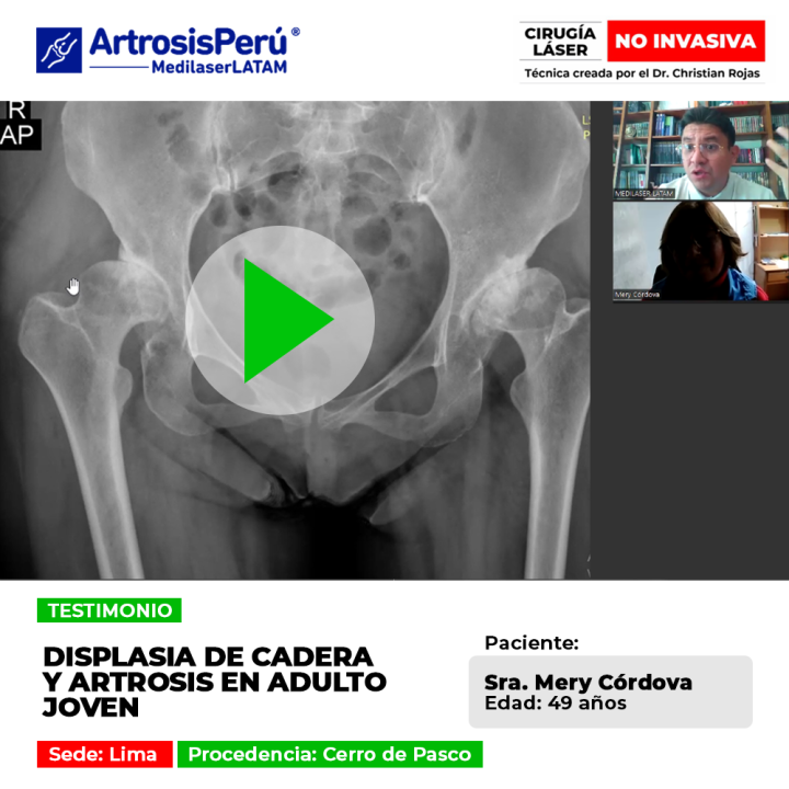 La displasia de cadera en adultos jóvenes puede provocar artrosis prematura. Infórmate sobre alternativas médicas para protegerla.