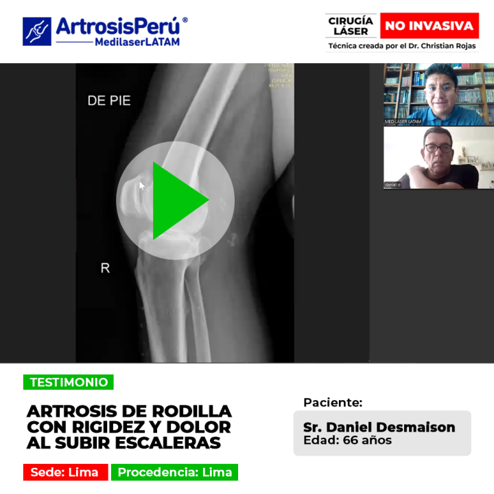 La artrosis de rodilla causa rigidez severa y dificulta subir escaleras a diario. Conoce tratamientos oportunos para recuperar fuerza.