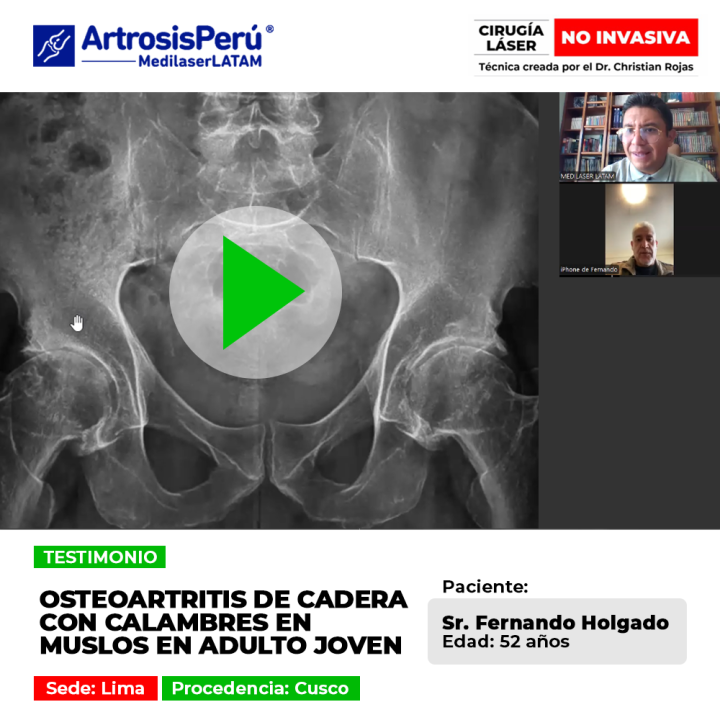 La osteoartritis cadera provoca dolor articular y molestos calambres musculares. Conoce alternativas médicas seguras para su alivio.