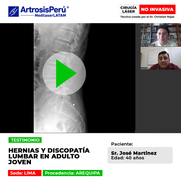 Las hernias y discopatía lumbar pueden limitar fuertemente la vida de adultos jóvenes. Conoce tratamientos eficaces para aliviarlas.