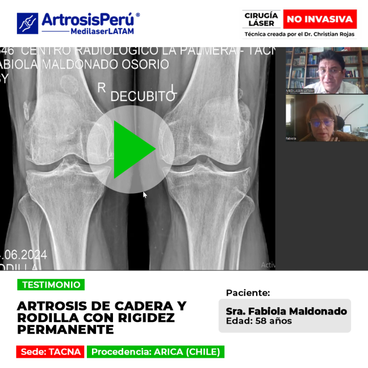 La artrosis de cadera y rodilla con rigidez continua dificulta los movimientos diarios. Descubre soluciones médicas para el alivio.