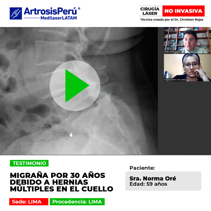 Las hernias múltiples cuello provocan migrañas crónicas de larga data. Infórmate sobre soluciones médicas para frenar este malestar.