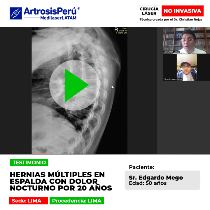 Las hernias múltiples espalda generan dolor crónico nocturno por años. Conoce tratamientos eficaces para lograr un verdadero descanso.