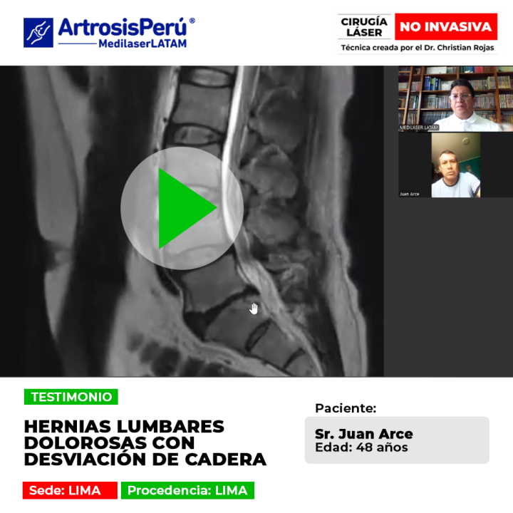 Las hernias lumbares dolorosas pueden provocar desviaciones en la cadera. Infórmate sobre alternativas médicas para recuperar postura.
