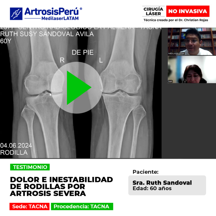 La artrosis severa rodillas causa dolor e inestabilidad al andar. Descubre procedimientos médicos seguros para frenar el desgaste.